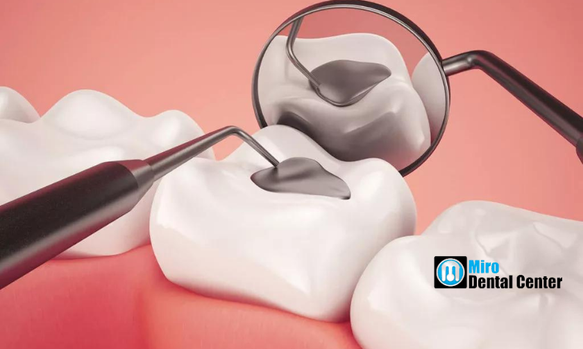 Featured image for “6 Advantages Of Dental Sealants”