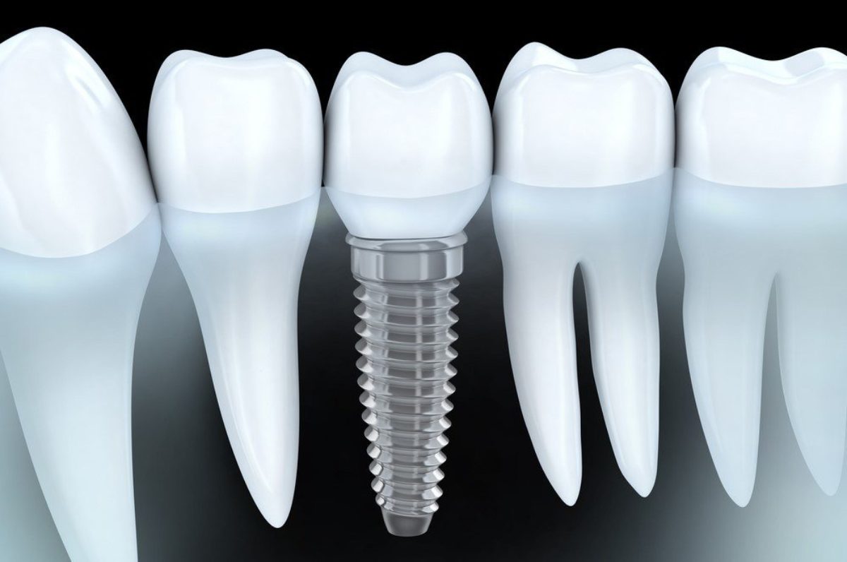 dental implant in coral gables fl, miro dental centers of coral gables