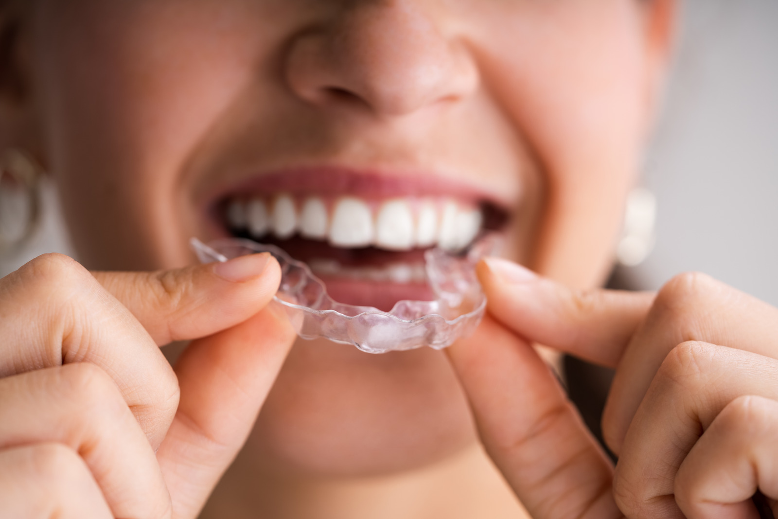 Invisalign Dentist in Coral Gables, Miro Dental Centers Of Coral Gables