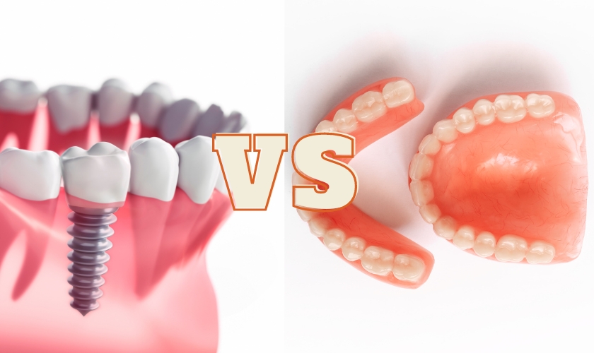 Featured image for “Dental Implants vs. Dentures: Cost & Insurance for Smile Restoration”