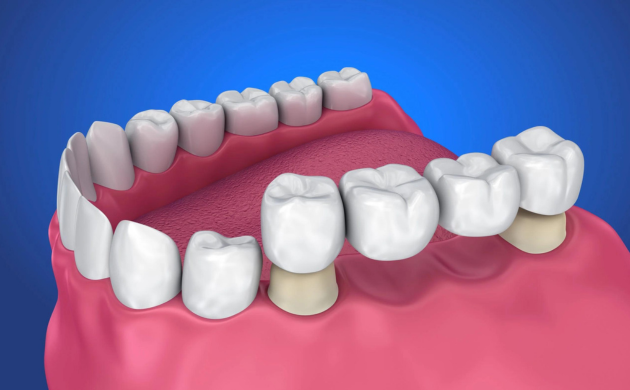 dental bridges coral gables