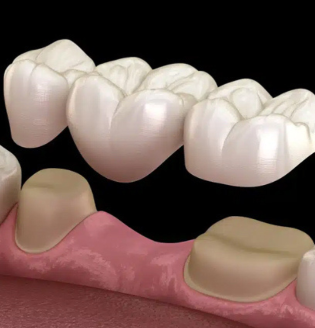 Dental Bridges - Miro Dental Centers Coral Gables