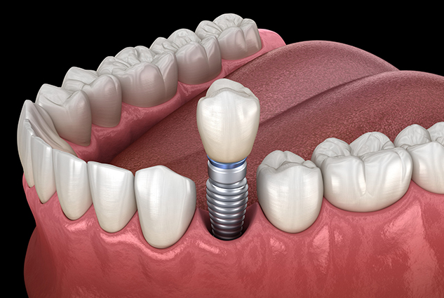 dental implant coral gables