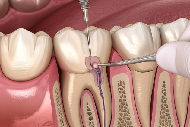 Root Canal Therapy Coral Gables FL