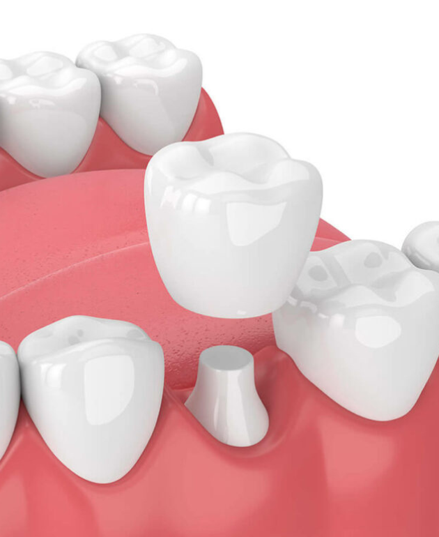 Dental Crowns Coral Gables, FL