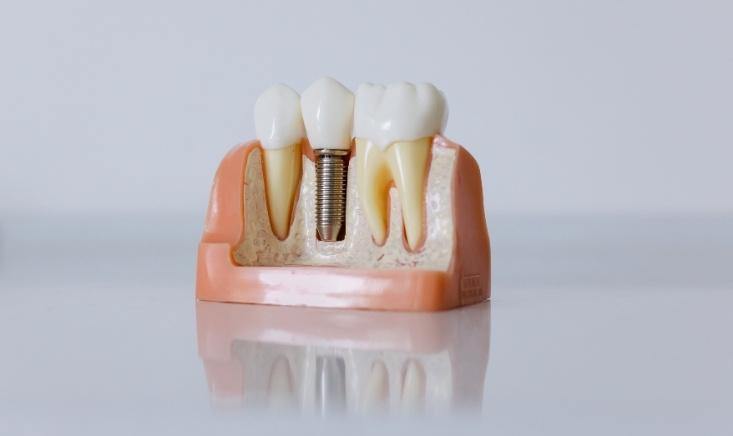 how long do dental implants last
