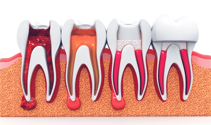comprehensive idea about root canal therapy
