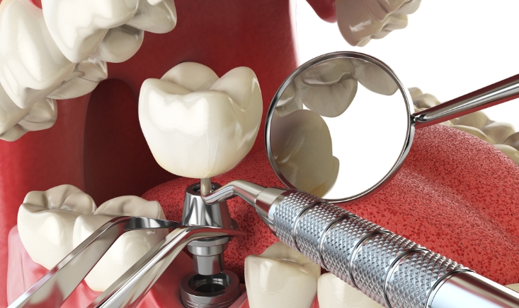 the most common complications after dental implant surgery