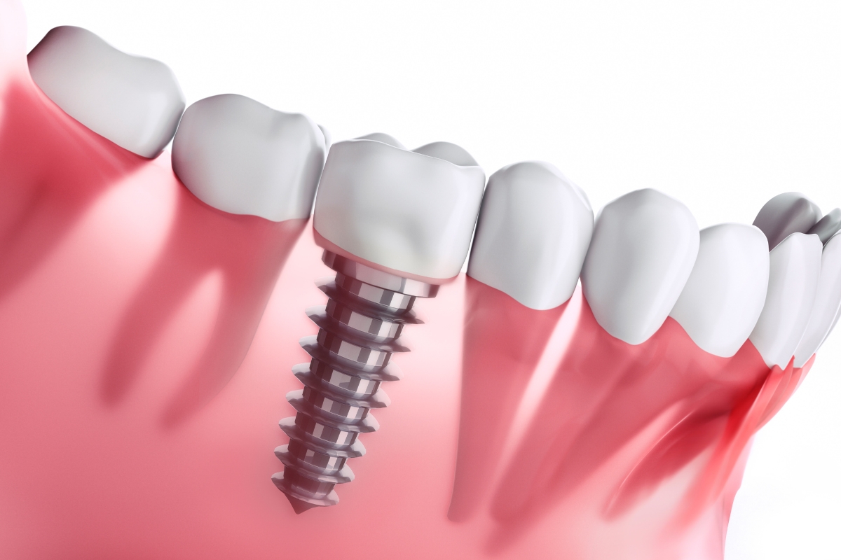 dental implants in Kendall